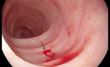 Viêm trợt hang vị là tình trạng tổn thương niêm mạc tại khu vực hang vị dạ dày