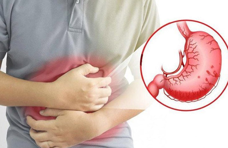 Bà con sẽ cảm nhận cơn đau nhẹ ở vùng trên rốn, đặc biệt là khi đói hoặc sau khi ăn no